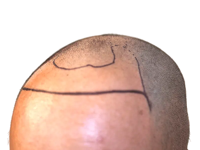 Hair transplant result: Man's shaved head with marked hairline. Hair restoration procedure shown. Before/after example.