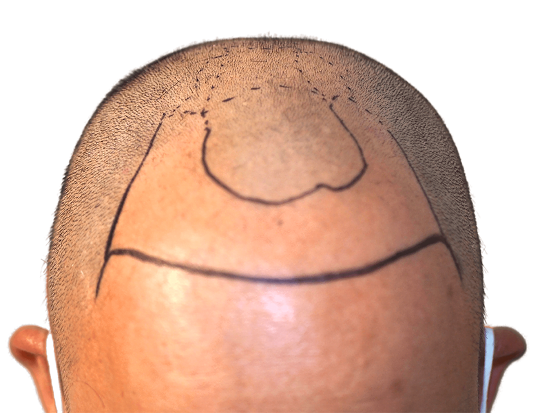 Hair transplant planning: Scalp marked for hair restoration. Before procedure, showing balding area and transplant guidelines.