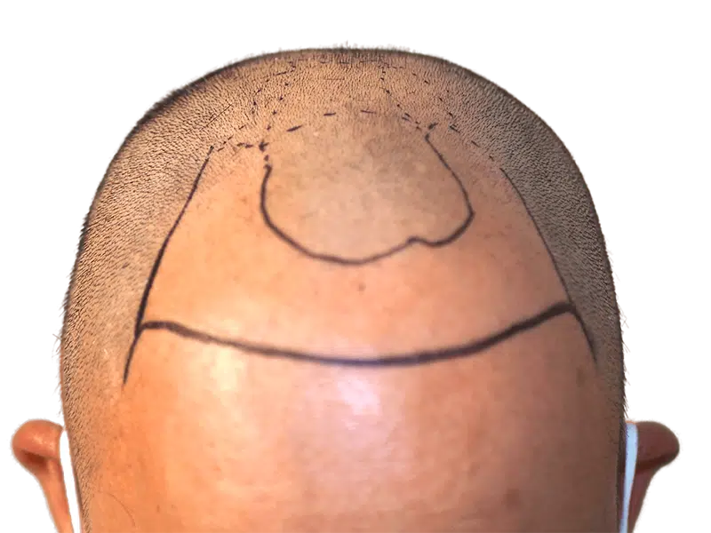 Hair transplant planning: Scalp marked for hair restoration. Before procedure, showing balding area and transplant guidelines.