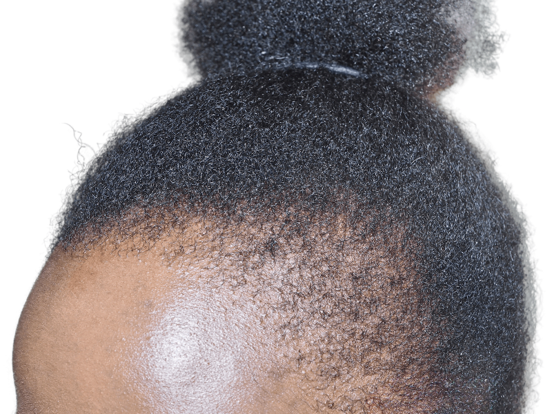 Natural Black hair texture & hairline. Could be a candidate for hair restoration or transplant. Before/After results vary.