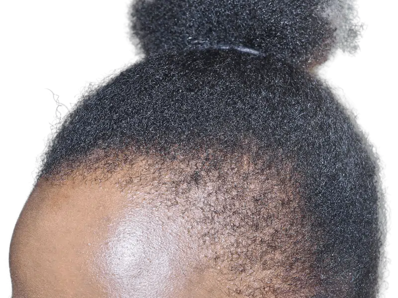 Natural Black hair texture & hairline. Could be a candidate for hair restoration or transplant. Before/After results vary.