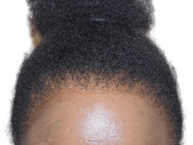 Natural hairline restoration. Dense, even hair growth. No visible transplant signs. Healthy, dark, tightly curled hair.