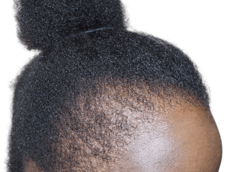 Natural hairline of African American woman. Consider hair restoration options for thinning or receding hairlines. Before/after possibilities.