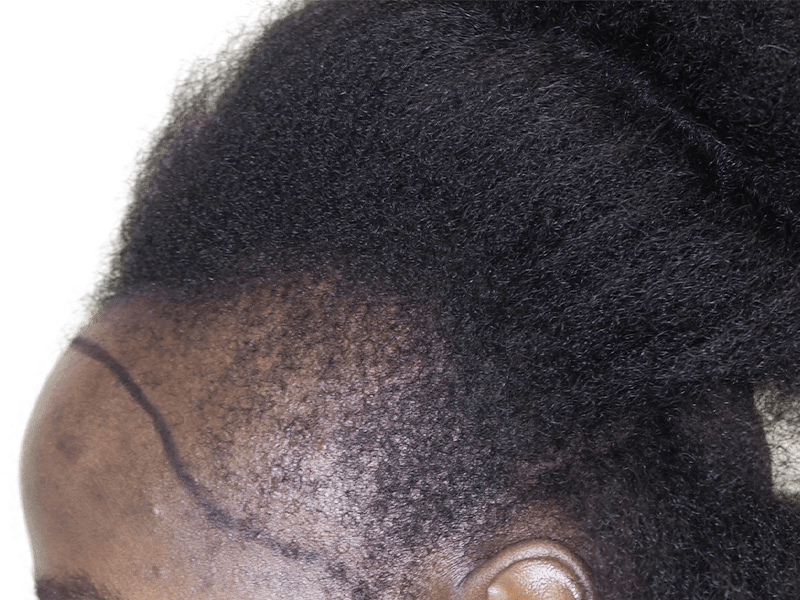 Hair transplant before & after: Restored hairline on African American/Hispanic patient. Hair restoration results.