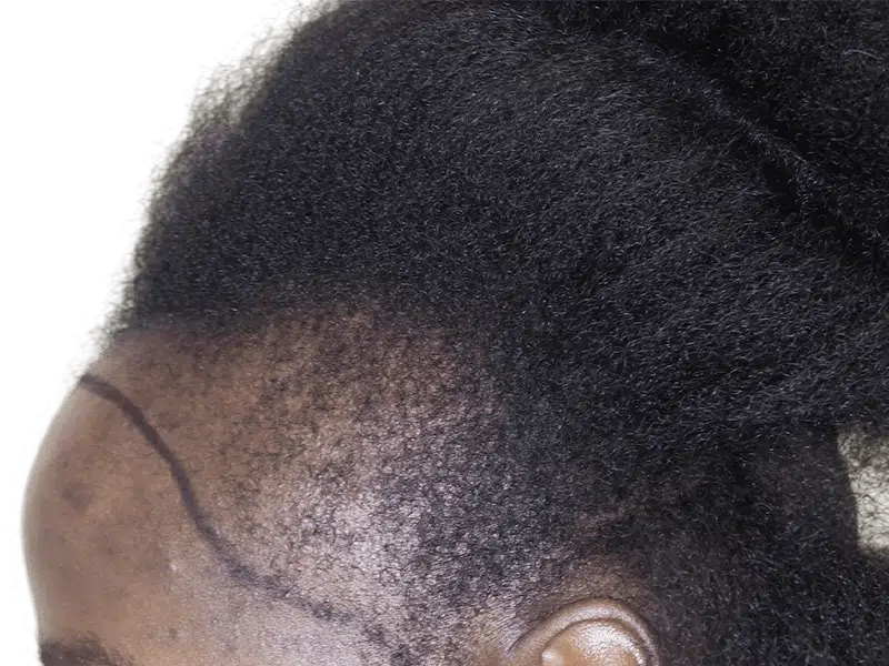 Hair transplant before & after: Restored hairline on African American/Hispanic patient. Hair restoration results.