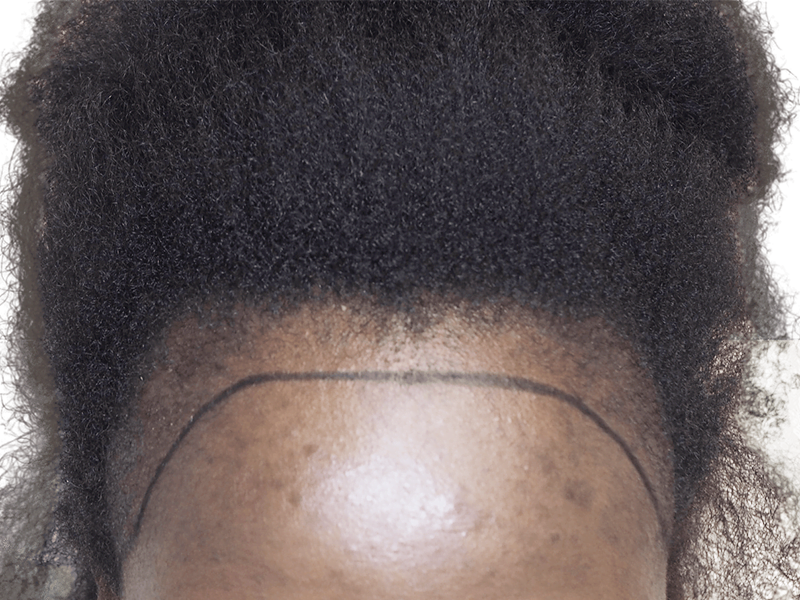 Hair transplant hairline on African American man. Before/after hair restoration results. Dense, curly hair. Hair loss treatment.