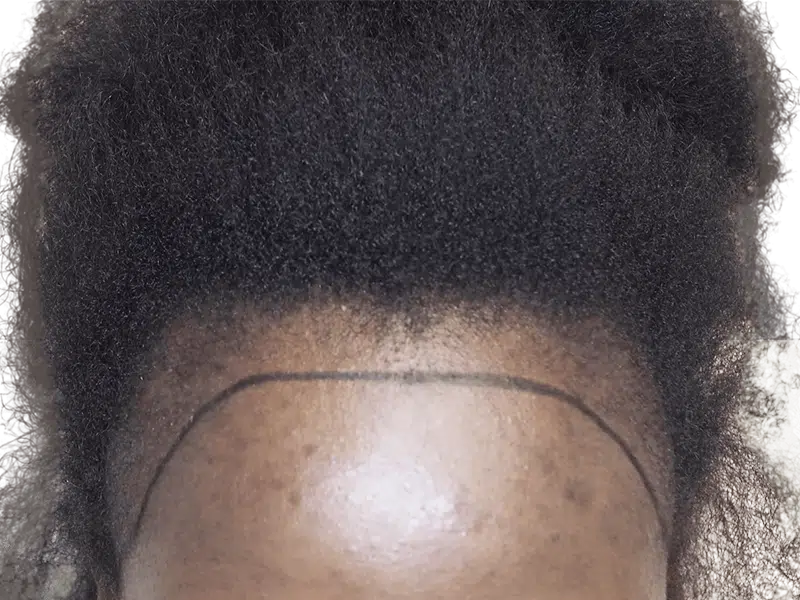 Hair transplant hairline on African American man. Before/after hair restoration results. Dense, curly hair. Hair loss treatment.