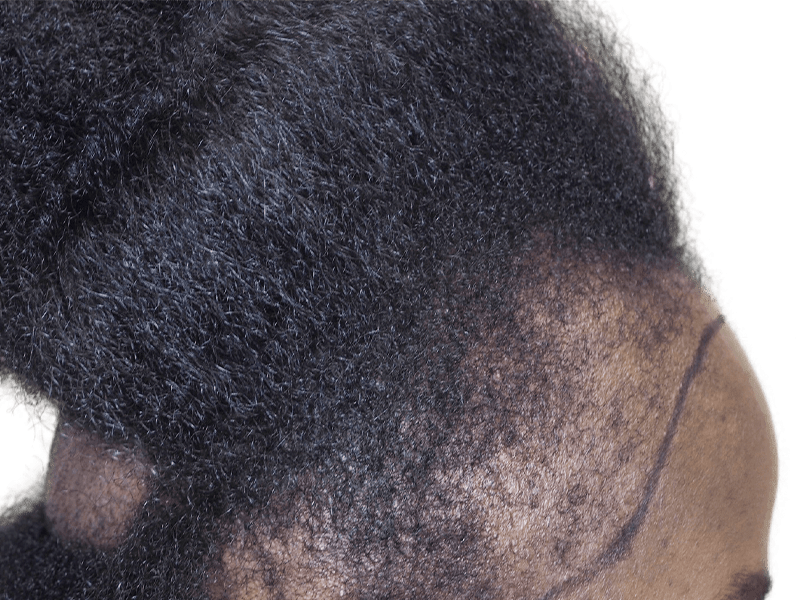 Hair transplant before & after: African American man. Improved hairline & density after hair restoration procedure.