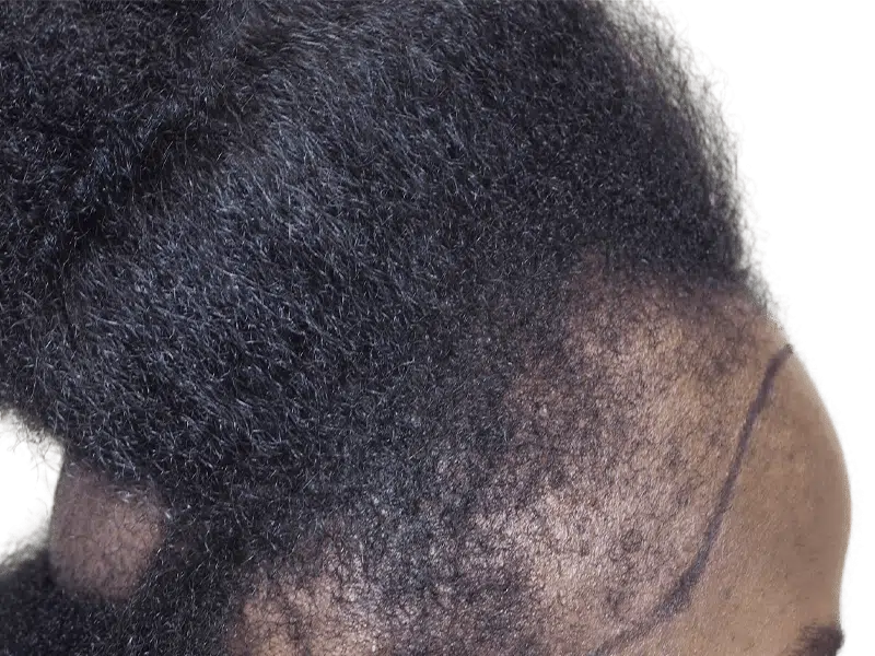 Hair transplant before & after: African American man. Improved hairline & density after hair restoration procedure.