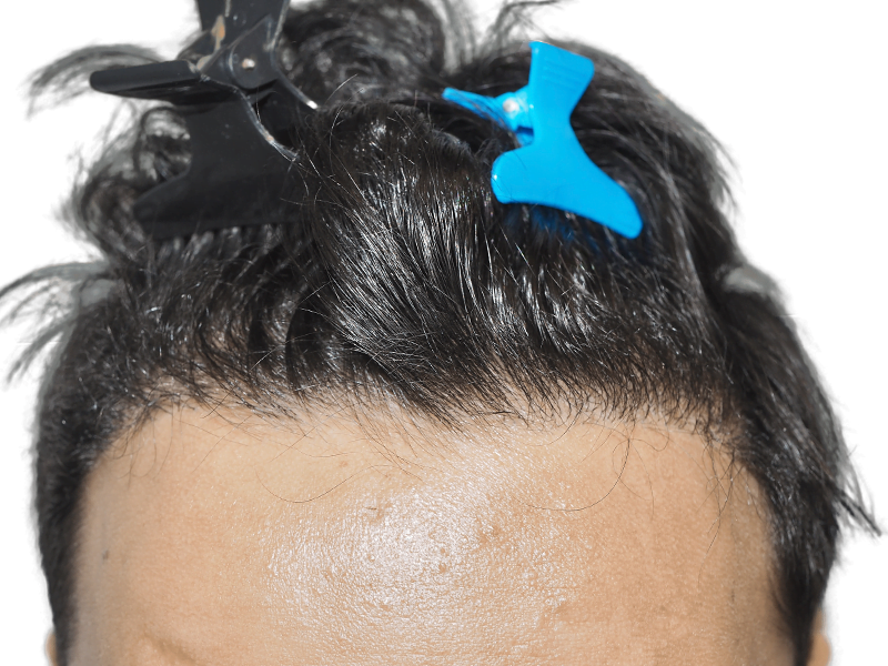 Before hair transplant: Receding hairline on Asian/Hispanic man. Hair restoration assessment. Hair clips in place.