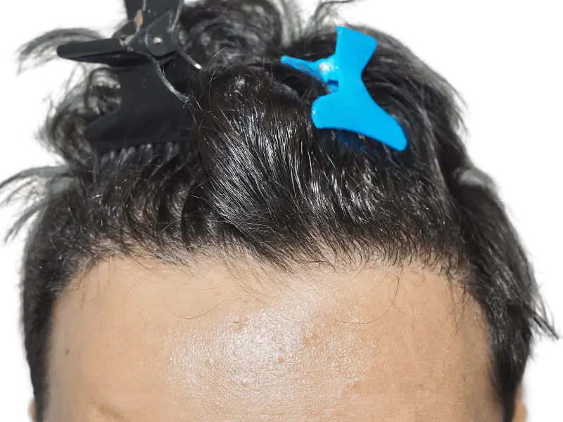 Before hair transplant: Receding hairline on Asian/Hispanic man. Hair restoration assessment. Hair clips in place.