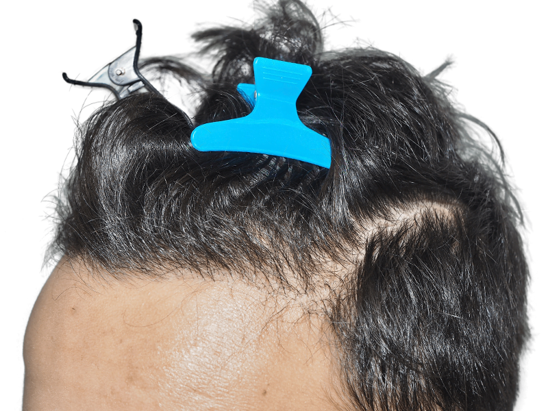 Hair transplant close-up. Receding hairline with dark hair, pre-procedure. Hair clips used for graft placement. Hair restoration.