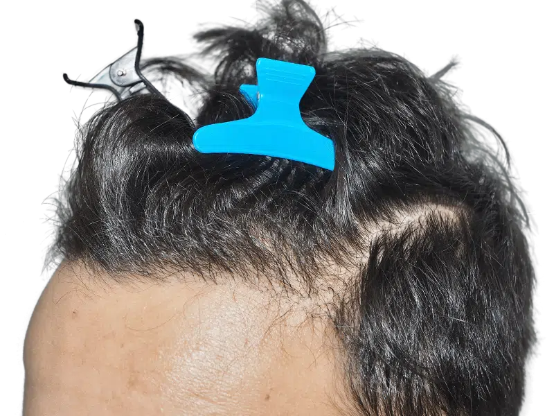 Hair transplant close-up. Receding hairline with dark hair, pre-procedure. Hair clips used for graft placement. Hair restoration.