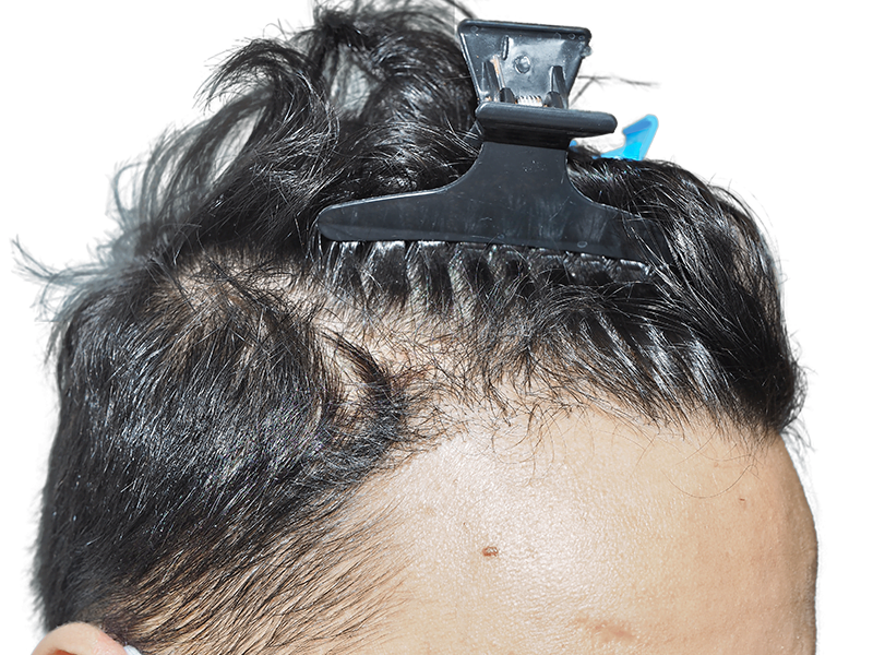 Receding hairline close-up. Potential hair transplant candidate. Before hair restoration procedure. Shows thinning hair.