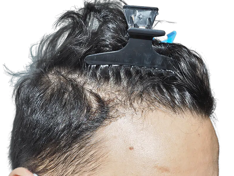 Receding hairline close-up. Potential hair transplant candidate. Before hair restoration procedure. Shows thinning hair.