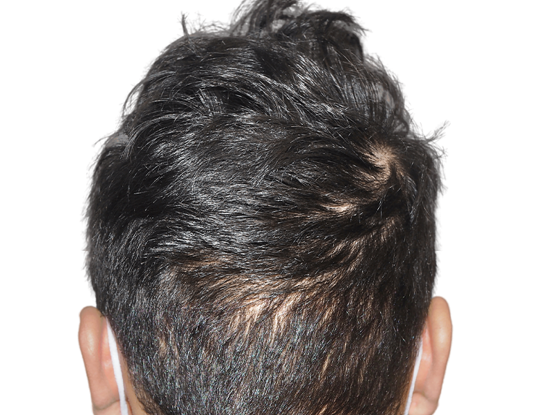 Thinning dark hair at the crown. Potential hair restoration candidate. Before hair transplant assessment.
