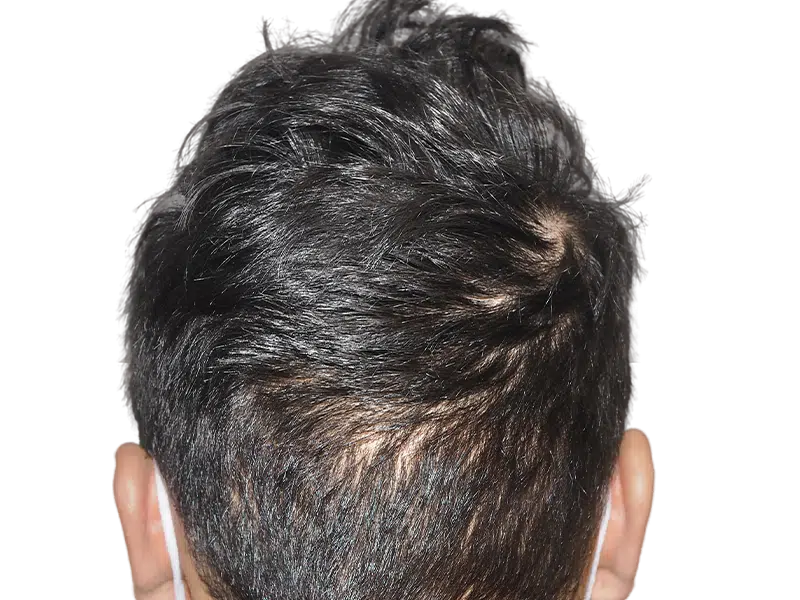 Thinning dark hair at the crown. Potential hair restoration candidate. Before hair transplant assessment.