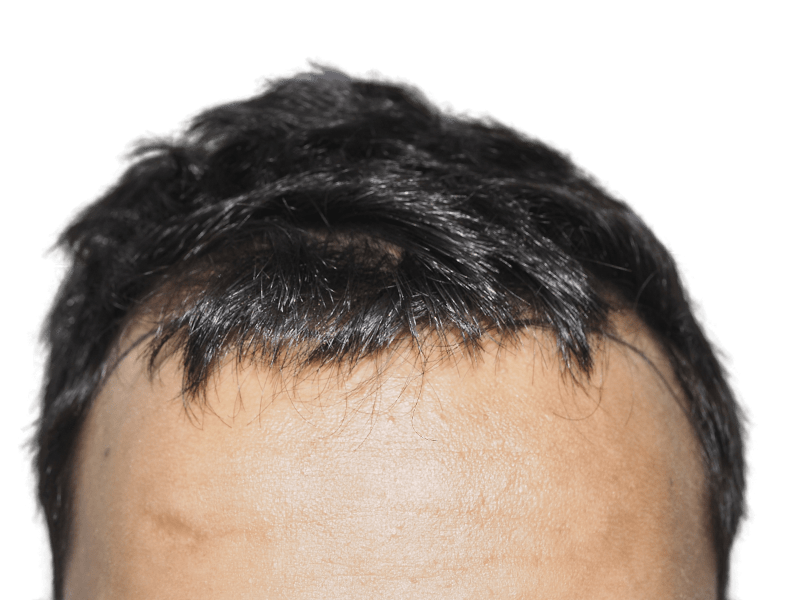Hairline close-up. Possible hair transplant scar. Consult for hair restoration options & before/after results.