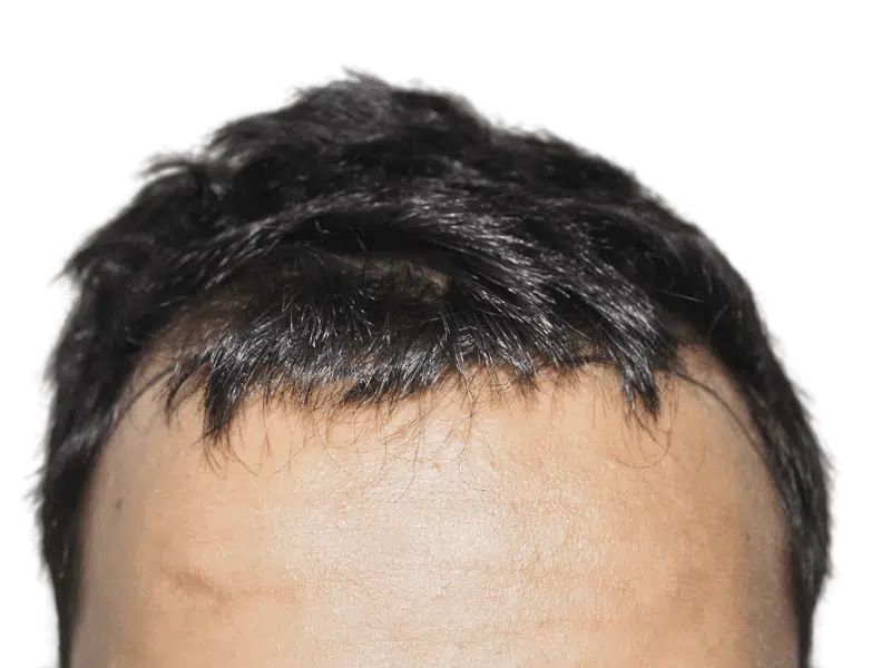 Hairline close-up. Possible hair transplant scar. Consult for hair restoration options & before/after results.