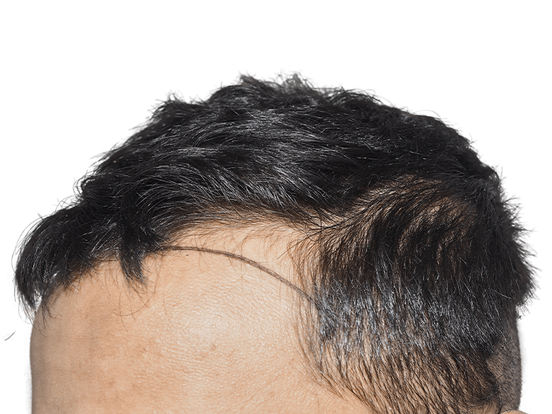 Thinning hairline (Asian descent). Before hair restoration/transplant. Visible scalp. Consider hair loss solutions.