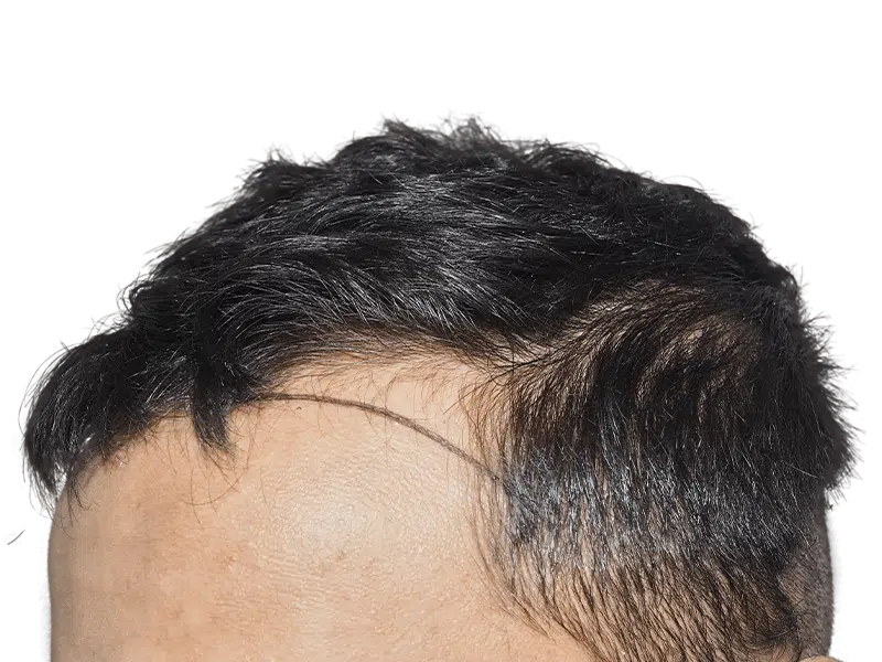 Thinning hairline (Asian descent). Before hair restoration/transplant. Visible scalp. Consider hair loss solutions.