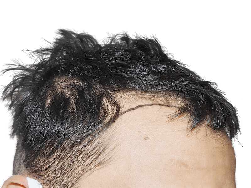 Hair transplant result: Receding hairline before restoration. Sparse, dark hair. Noticeable density difference. Mole visible.