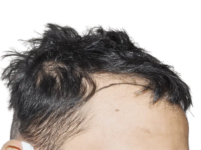 Hair transplant result: Receding hairline before restoration. Sparse, dark hair. Noticeable density difference. Mole visible.