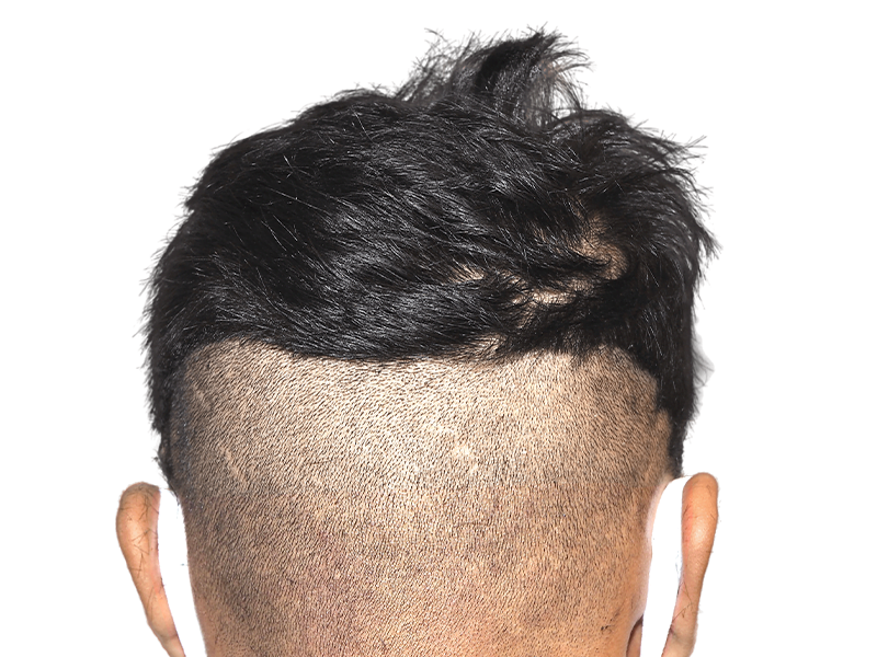 Hair transplant before/after: Shaved donor area & longer transplanted hair on a Hispanic/African American man. Hair restoration results.