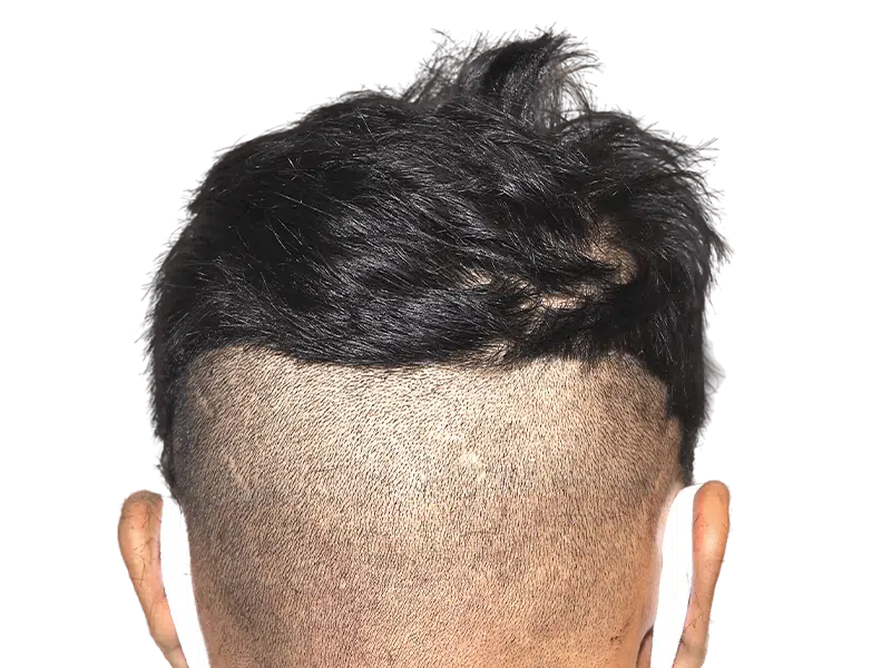 Hair transplant before/after: Shaved donor area & longer transplanted hair on a Hispanic/African American man. Hair restoration results.