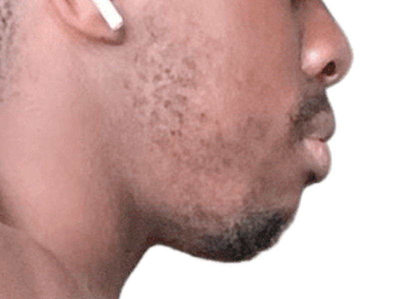 Man's profile. Possible hair transplant recipient? Close-up of hairline/beard. Hair restoration results may vary.