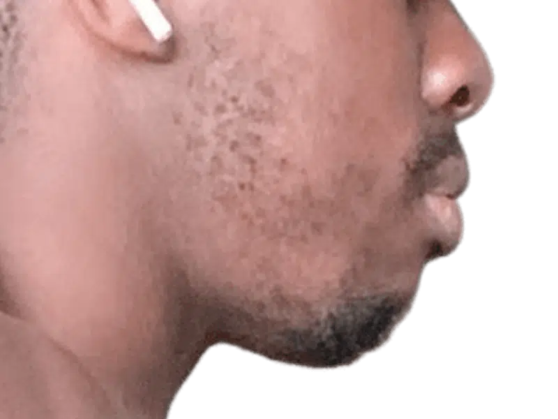Man's profile. Possible hair transplant recipient? Close-up of hairline/beard. Hair restoration results may vary.