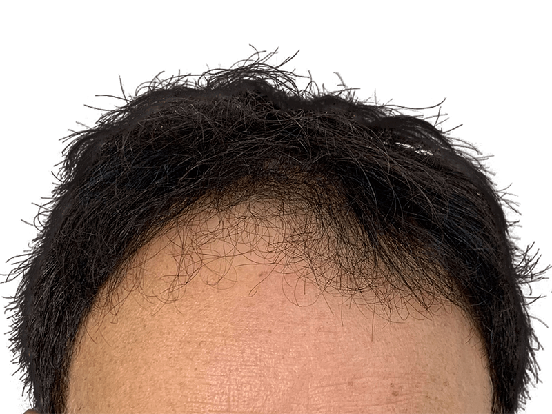 Receding hairline. Hair thinning example. Potential hair restoration candidate. Before hair transplant consideration.
