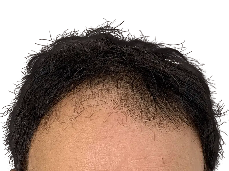 Receding hairline. Hair thinning example. Potential hair restoration candidate. Before hair transplant consideration.
