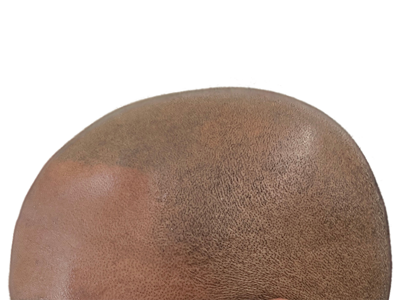 Hair transplant result: African American/Hispanic male's fuller head of hair. Restored hairline, short hair. Hair restoration procedure.