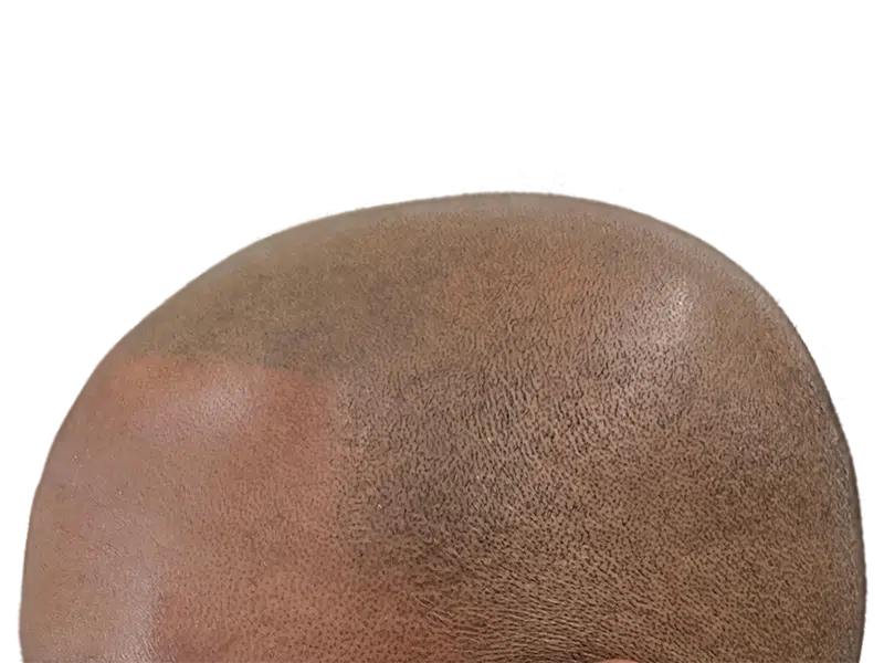 Hair transplant result: African American/Hispanic male's fuller head of hair. Restored hairline, short hair. Hair restoration procedure.