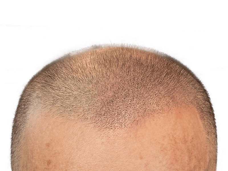 Hair transplant before & after. Caucasian man with light brown hair shows improved density after hair restoration procedure.
