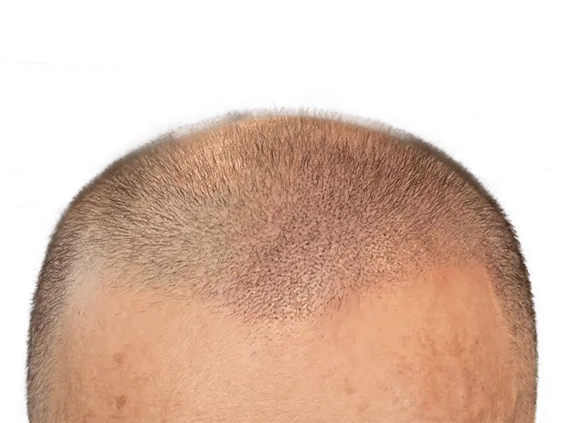 Hair transplant before & after. Caucasian man with light brown hair shows improved density after hair restoration procedure.