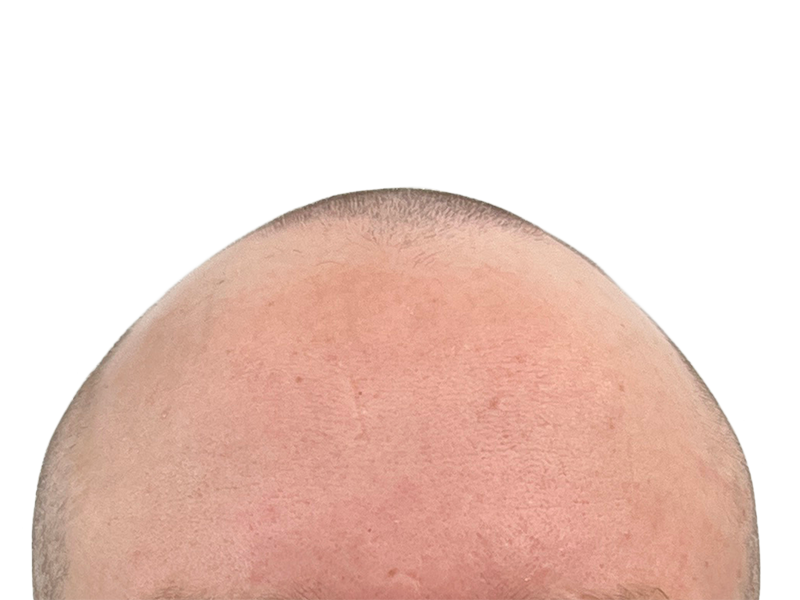 Receding hairline. Hair loss treatment consideration. Possible hair transplant before. Consult for restoration options.