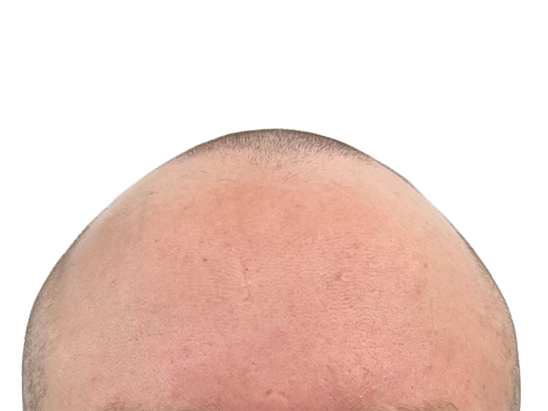 Balding man's head. Potential hair transplant candidate. Hair restoration before photo. Light skin tone, receding hairline.