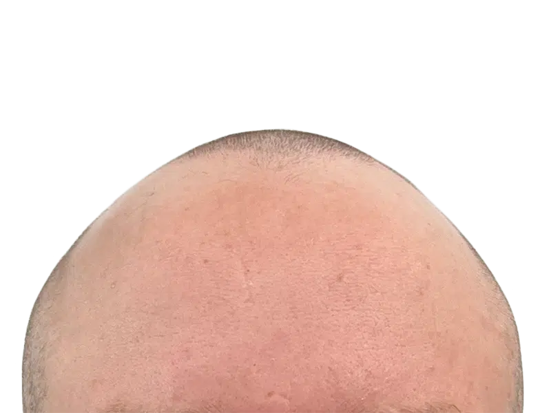 Balding man's head. Potential hair transplant candidate. Hair restoration before photo. Light skin tone, receding hairline.