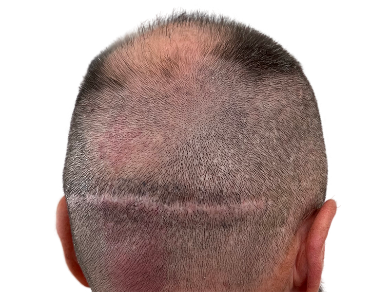 FUT hair transplant scar on back of head. Hair thinning above. Hair restoration procedure result.