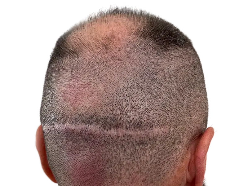 FUT hair transplant scar on back of head. Hair thinning above. Hair restoration procedure result.