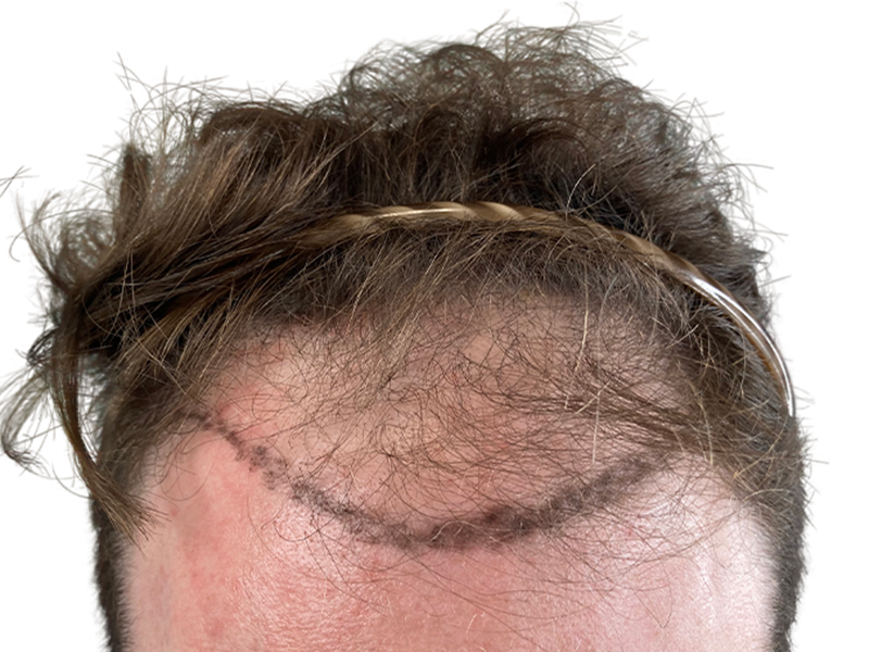 Hair transplant result: New hairline with implanted follicles. Light brown hair, fair skin. Hair restoration success.