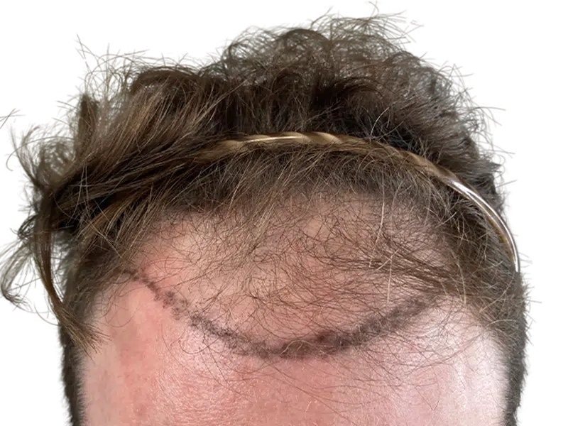 Hair transplant result: New hairline with implanted follicles. Light brown hair, fair skin. Hair restoration success.