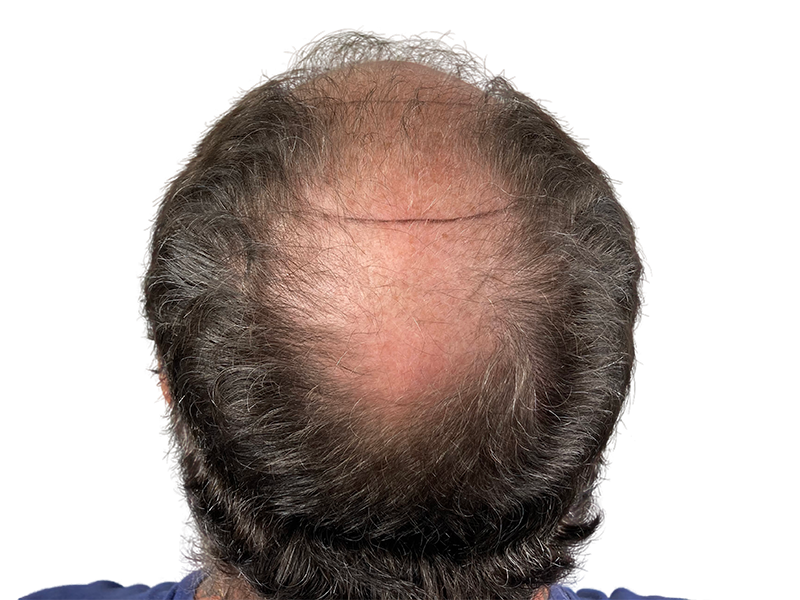 Thinning hair on top of head. Potential hair restoration candidate. Consider hair transplant options for fuller hair.