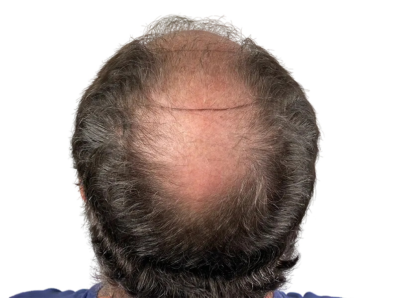 Thinning hair on top of head. Potential hair restoration candidate. Consider hair transplant options for fuller hair.