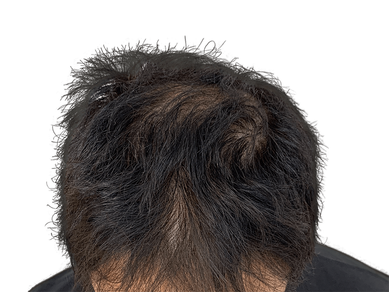 Thinning dark hair, receding hairline. Potential hair loss candidate. Consider hair restoration or transplant options.