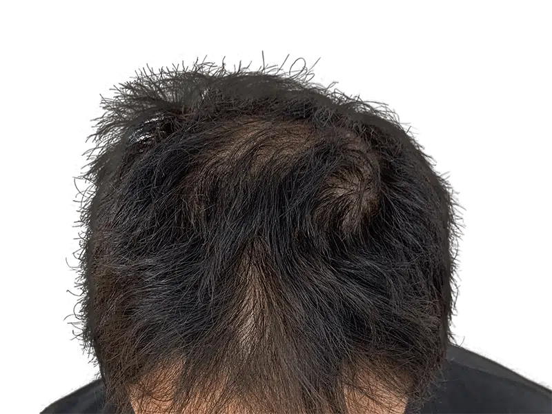 Thinning dark hair, receding hairline. Potential hair loss candidate. Consider hair restoration or transplant options.