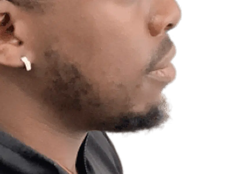 Man's profile: Before hair transplant. Short hair, beard. Hair restoration results possible. Earring visible.