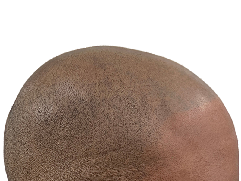 Close-up of scalp showing hair follicles. Could be before/after hair restoration or transplant. Skin tone variation visible.